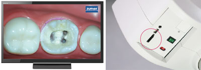 歯科用マイクロスコープ ブライトビジョン2380 静止画と動画の記録システム